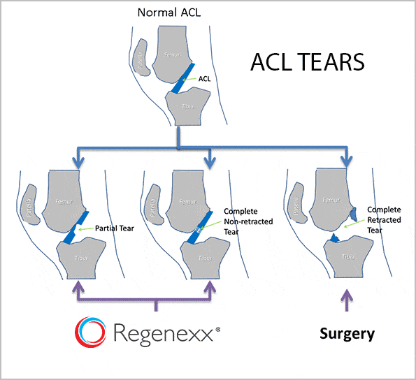 Regenexx ACL Repair For Torn Anterior Cruciate Ligament Andrew M 